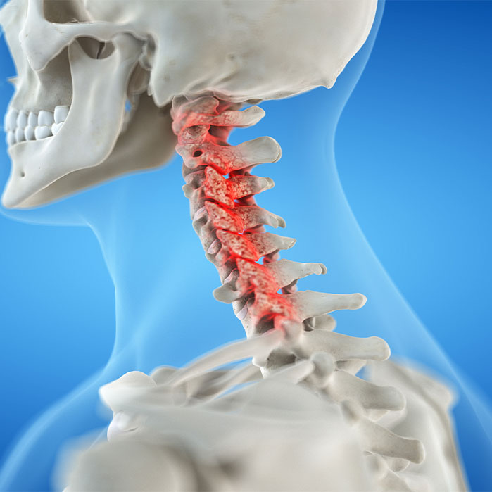 bone spur treatment in Turlock CA