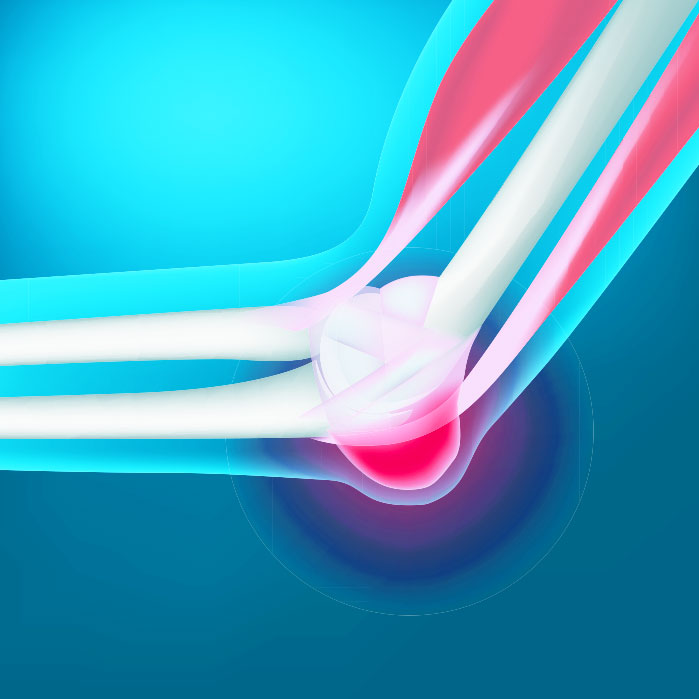 bursitis chiropractor in Turlock CA