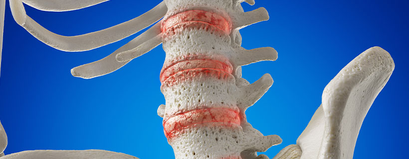 patient needing degenerative disc disease treatment in Turlock