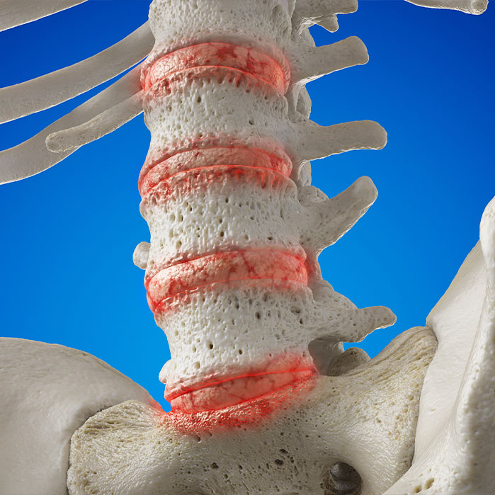 degenerative disc disease treatment in Turlock CA