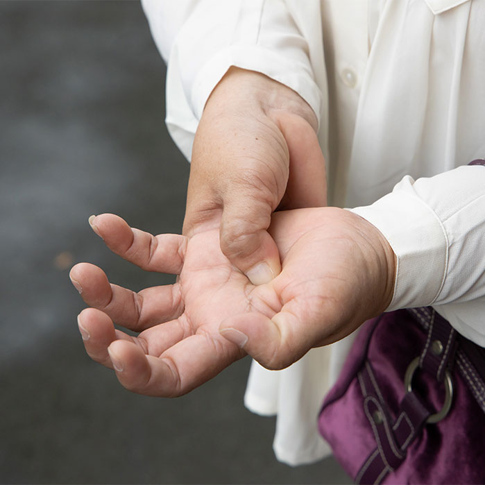 dupuytren contracture chiropractor in Turlock CA