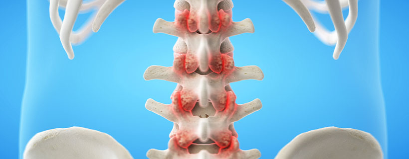 patient needing facet joint syndrome treatment in Turlock