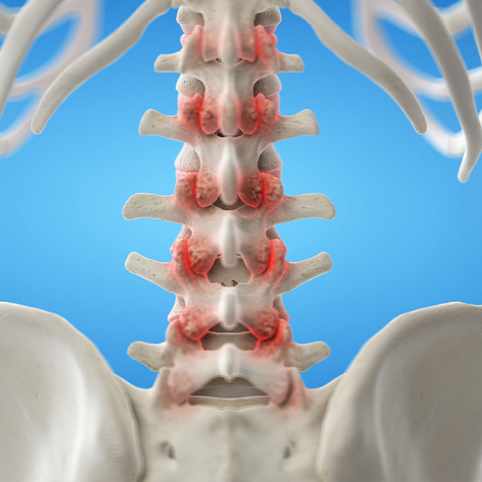 facet joint syndrome treatment in Turlock CA