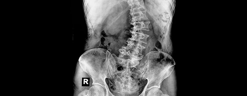 patient needing scoliosis treatment in Turlock