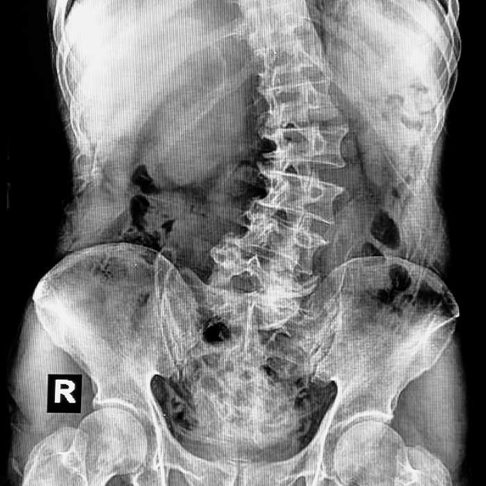 scoliosis chiropractor in Turlock CA