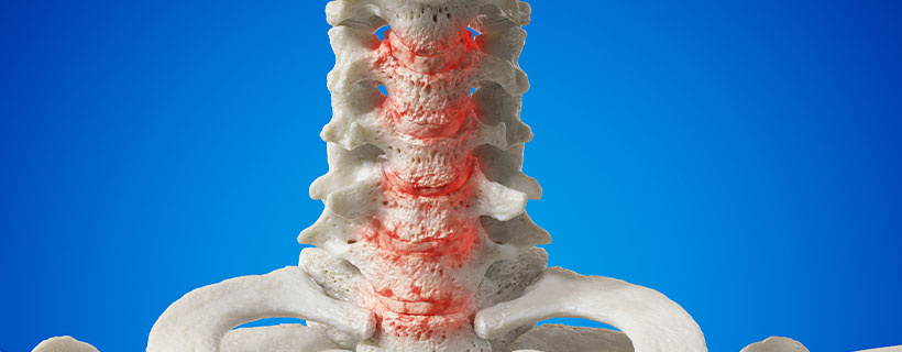 patient needing spondylosis treatment in Turlock