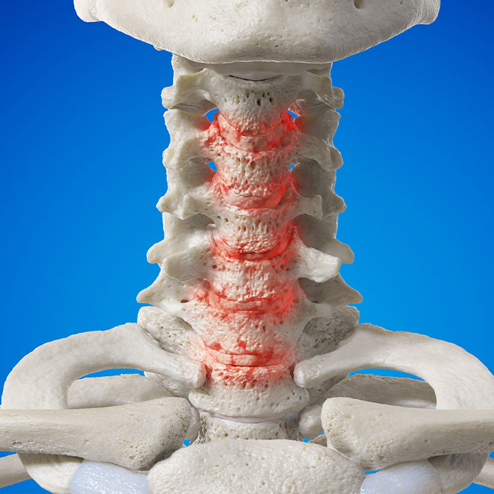 spondylosis treatment in Turlock CA