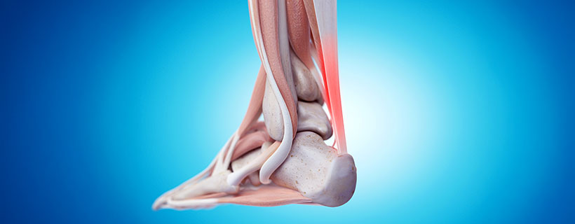 patient needing tendonitis treatment in Turlock