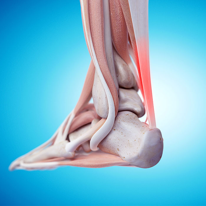 tendonitis chiropractor in Turlock CA